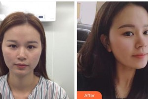 包頭華美醫(yī)療美容醫(yī)院王金紅整形價(jià)格表附耳軟骨復(fù)合隆鼻例展示