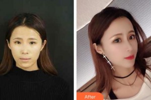 烏海市人民醫(yī)院整形外科馬語遙整形價格表附耳軟骨復合隆鼻案例展示