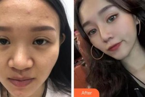 赤峰現(xiàn)代婦產(chǎn)醫(yī)院醫(yī)療美容科袁俊龍整形價格表附鼻部綜合案例展示