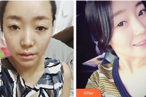 赤峰麗都整形美容醫(yī)院潘福強(qiáng)整形價(jià)格表附鼻部綜合案例展示