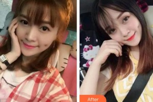 赤峰市醫(yī)院燒傷整形美容科孟凡軍整形價(jià)格表附眼部綜合案例展示