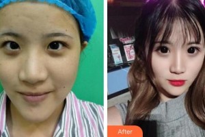 赤峰淑香醫(yī)療整形美容醫(yī)院喬淑香整形價(jià)格表附切開雙眼皮案例展示