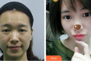 通遼京韓創(chuàng)美醫(yī)療美容診所子墨整形價(jià)格表附切開雙眼皮案例展示