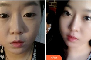 通遼新時(shí)代醫(yī)療美容診所吳瓊整形價(jià)格表附切開雙眼皮案例展示