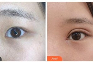 通遼京韓創(chuàng)美醫(yī)療美容診所葉珊整形價(jià)格表附眼部綜合案例展示