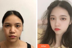 鄂爾多斯天王醫(yī)學(xué)美容醫(yī)院吳麗英整形價(jià)格表附去痘印痘坑案例展示