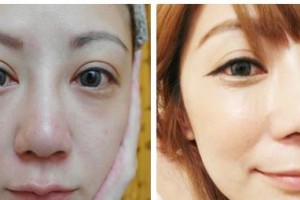 鄂爾多斯天王醫(yī)學(xué)美容醫(yī)院王殿博整形價(jià)格表附光子嫩膚案例展示