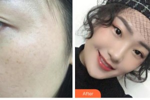 鄂爾多斯武瑞明醫(yī)學(xué)美容整形醫(yī)院武瑞明整形價(jià)格表附激光祛斑案例展示