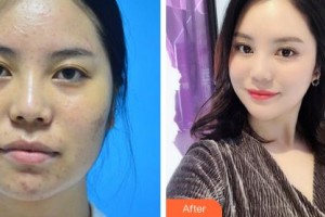 鄂爾多斯天王醫(yī)學(xué)美容醫(yī)院王淑珍整形價格表附去痘印痘坑案例展示