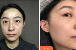 鄂爾多斯口腔醫(yī)院楊劍整形價格表附激光祛斑案例展示