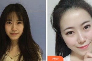 鄂爾多斯天王醫(yī)學(xué)美容醫(yī)院梁曉健整形價格表附無針水光案例展示