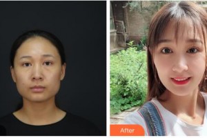 呼倫貝爾周彩蓮醫(yī)療美容診所周彩蓮整形價格表附眼部綜合案例展示