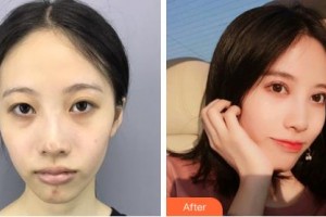 巴彥淖爾張紅田醫(yī)療整形美容診所賀新華整形價格表附眼部綜合案例展示