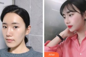 烏蘭察布美尚美醫(yī)學(xué)美容整形醫(yī)院樸圣勛整形價格表附眼部綜合案例展示