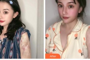 吉林銘醫(yī)整形美容醫(yī)院劉浩整形價格表附微創(chuàng)疤痕修復案例展示