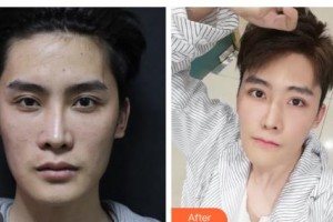 吉林大學口腔醫(yī)院口腔頜面外科彭鐵男整形價格表附牙齒隱形矯正案例展示