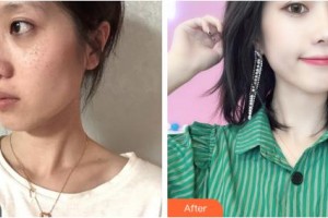 吉林大學第一醫(yī)院整形美容科劉海鵬整形價格表附激光祛斑案例展示