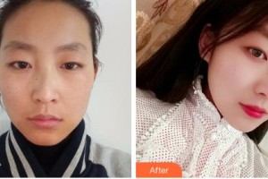 吉林大學(xué)第一醫(yī)院整形美容科榮莉整形價格表附光子嫩膚案例展示