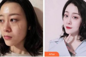 吉林省公安邊防總隊醫(yī)院醫(yī)整形美容中心王磊整形價格表附微創(chuàng)疤痕修復案例展示