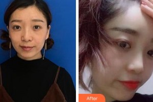 吉林瑞澳醫(yī)學(xué)美容醫(yī)院張建亮整形價格表附玻尿酸精華導(dǎo)入案例展示