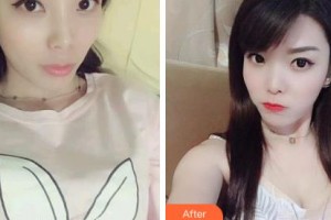 吉林銘醫(yī)整形美容醫(yī)院尤海濱整形價格表附白瓷娃娃案例展示