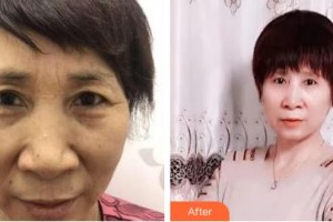 吉林市中心醫(yī)院燒傷整形外科宋博住院醫(yī)師整形價格表附切眉術(shù)案例展示