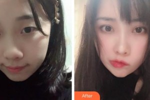 吉林大學(xué)中日聯(lián)誼醫(yī)院燒傷整形外科林駐煥整形價格表附眼部綜合案例展示