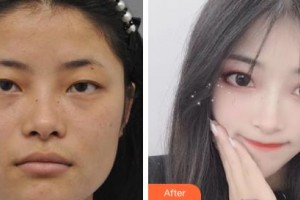 吉林省人民醫(yī)院燒傷整形科劉進(jìn)輝整形價格表附眼部綜合案例展示