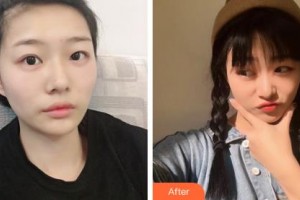 長春劉金梅美容整形外科診所劉金梅整形價格表附激光去眼袋案例展示