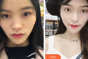 長春韓一美容醫(yī)院金鐘皖整形價格表附耳軟骨復合隆鼻案例展示