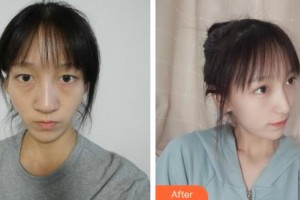 長春海峽美容醫(yī)院孟憲勇整形價格表附耳軟骨復合隆鼻案例展示