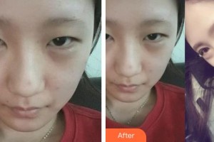 長春珍妮醫(yī)療美容醫(yī)院鄭乃誠整形價格表附眼部綜合案例展示