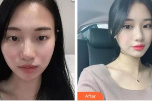 長春秀爾醫(yī)療美容診所樸永男整形價格表附眼部修復案例展示