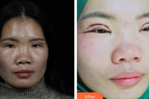 長春正韓醫(yī)療美容醫(yī)院林偉卓整形價格表附切開雙眼皮案例展示