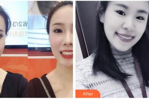 長春海峽美容醫(yī)院孟慶思整形價格表附牙齒隱形矯正案例展示