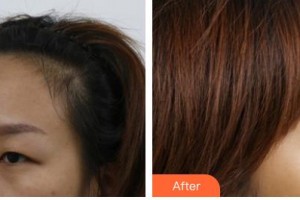 長春愛麗醫(yī)療美容門診部金詠晙整形價格表附上眼瞼去脂案例展示