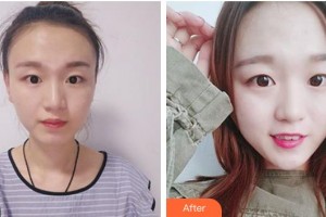 長春西之米醫(yī)療美容醫(yī)院徐嘉整形價格表附切眉術案例展示