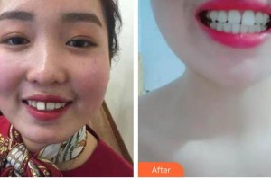 長春珍妮醫(yī)療美容醫(yī)院王廣平整形價格表附牙齒隱形矯正案例展示