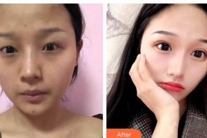 長春圣華抗衰老醫(yī)學研究院崔林整形價格表附激光去眼袋案例展示