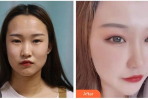 長春圣華抗衰老醫(yī)學研究院池岳龍整形價格表附眼部綜合案例展示