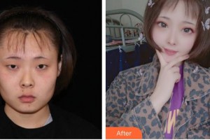 長春華璦美容醫(yī)院龔春靜整形價格表附眼部綜合案例展示