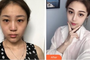 長春奧拉克美容醫(yī)院鄭瑩整形價格表附假體隆鼻案例展示