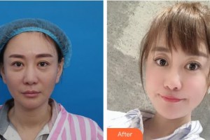 長春正韓醫(yī)療美容醫(yī)院謝升偉整形價格表附埋線提升案例展示