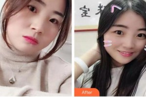 長春非凡美容整形醫(yī)院孫琦整形價格表附埋線提升案例展示