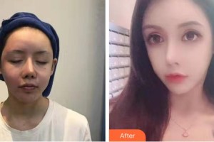 長春洪鵬醫(yī)療美容門診部寇海東整形價格表附熱拉提案例展示