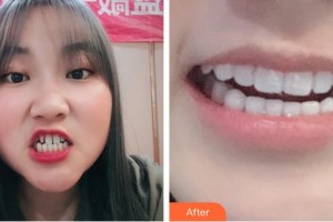 長春欣雅口腔門診部樸月梅住院醫(yī)師整形價(jià)格表附牙貼面案例展示