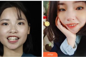 長春白求恩口腔醫(yī)院楊溢整形價(jià)格表附金屬托槽矯正案例展示