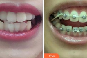 長春詩邁爾口腔門診部宋邦嘯整形價(jià)格表附金屬托槽矯正案例展示