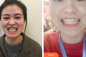 長春尚氏華醫(yī)美容整形門診部戰(zhàn)大民整形價格表附冷光美白案例展示