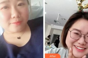 四平市燒傷整形醫(yī)院李笑豐整形價格表附牙齒隱形矯正案例展示